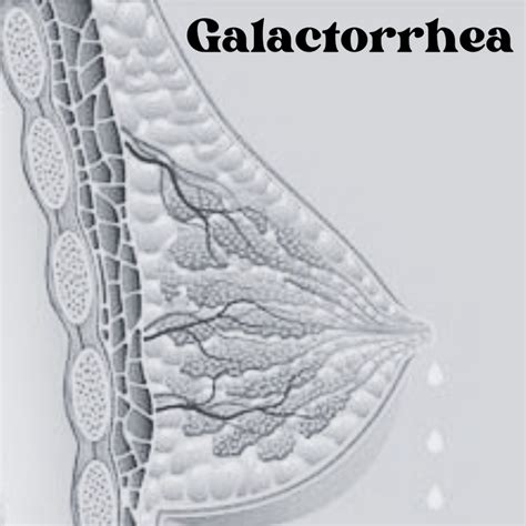 is galactorrhea safe to drink|Galactorrhea: Symptoms, Causes, and Treatment